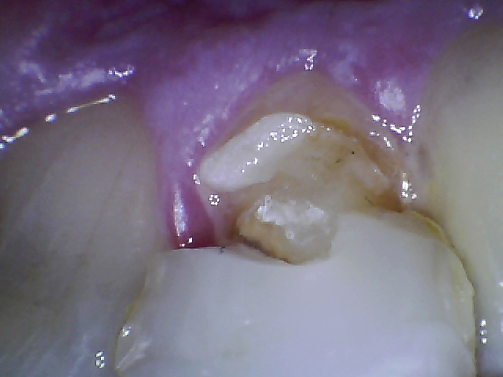 Front crown just fell off, do any home cements work as well as dentist