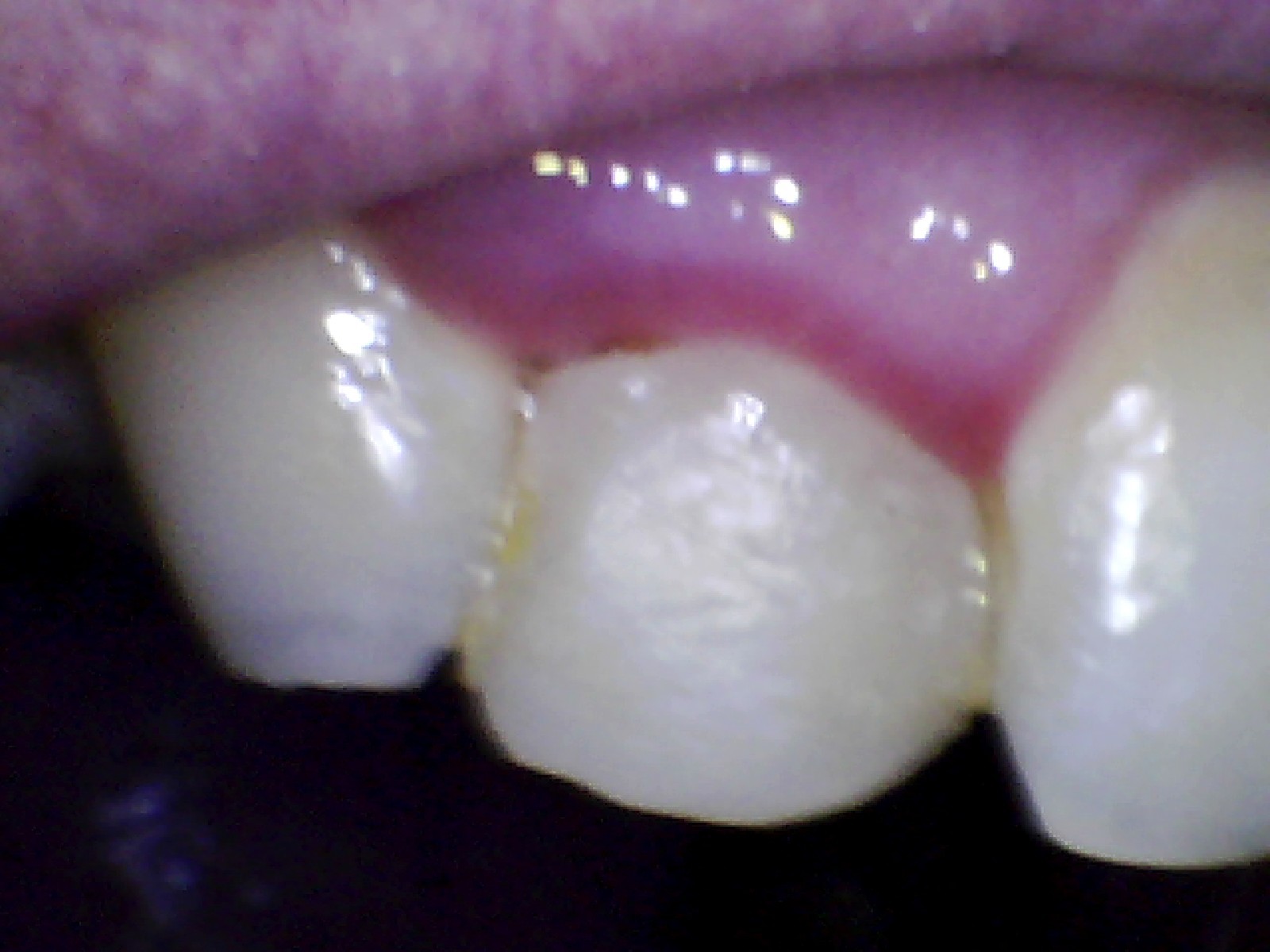 Front crown just fell off, do any home cements work as well as dentist